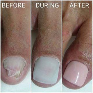 Gel Toe Nail Reconstruction Course-SA Training Academy